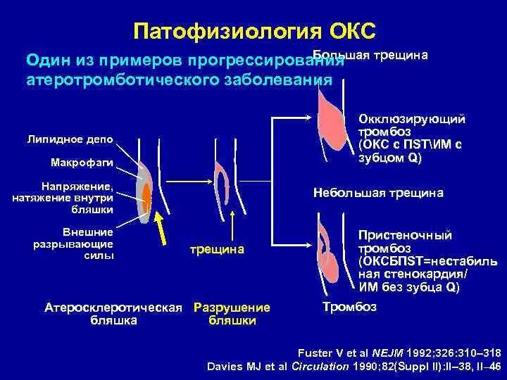 Острый коронарный синдром инфаркт. Острый коронарный синдром этиология. Патогенез острого инфаркта миокарда. Острый коронарный синдром патофизиология. Патогенез Окс.