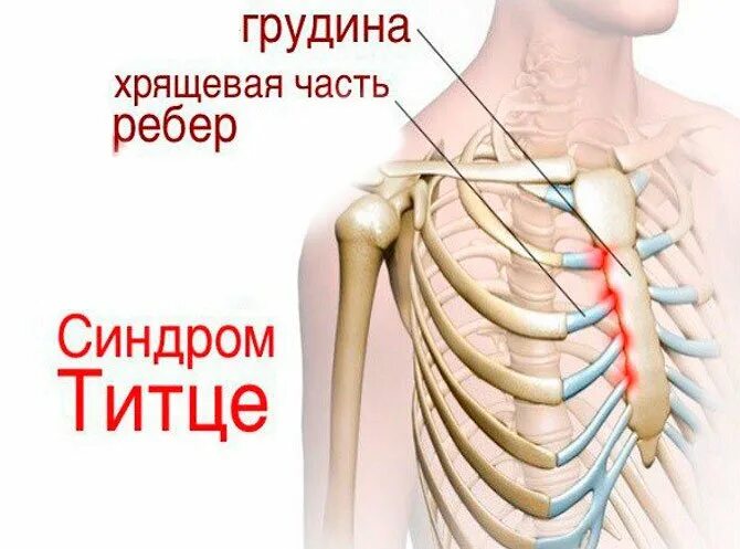 Боль между ребрами спереди