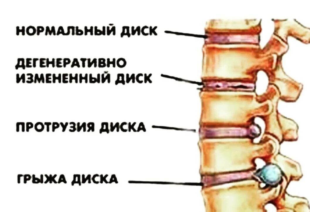 Протрузия межпозвонкового диска th8/th9. Грыжа диска и протрузия диска. Грыжа межпозвонкового диска th8-th9. Протрузии позвонков поясничного отдела.