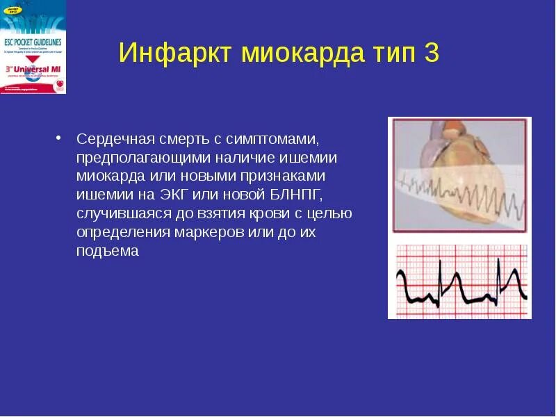 5 тип острого инфаркта. Типы инфаркта миокарда. третий тип инфаркта.