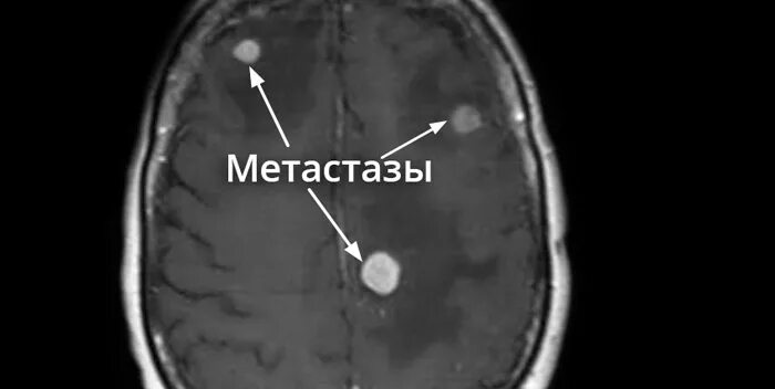 Метастазы в мозгу форум. Метастазы в головном мозге. Метастазы меланомы в головной мозг кт. Опухоль мозга с метастазами.