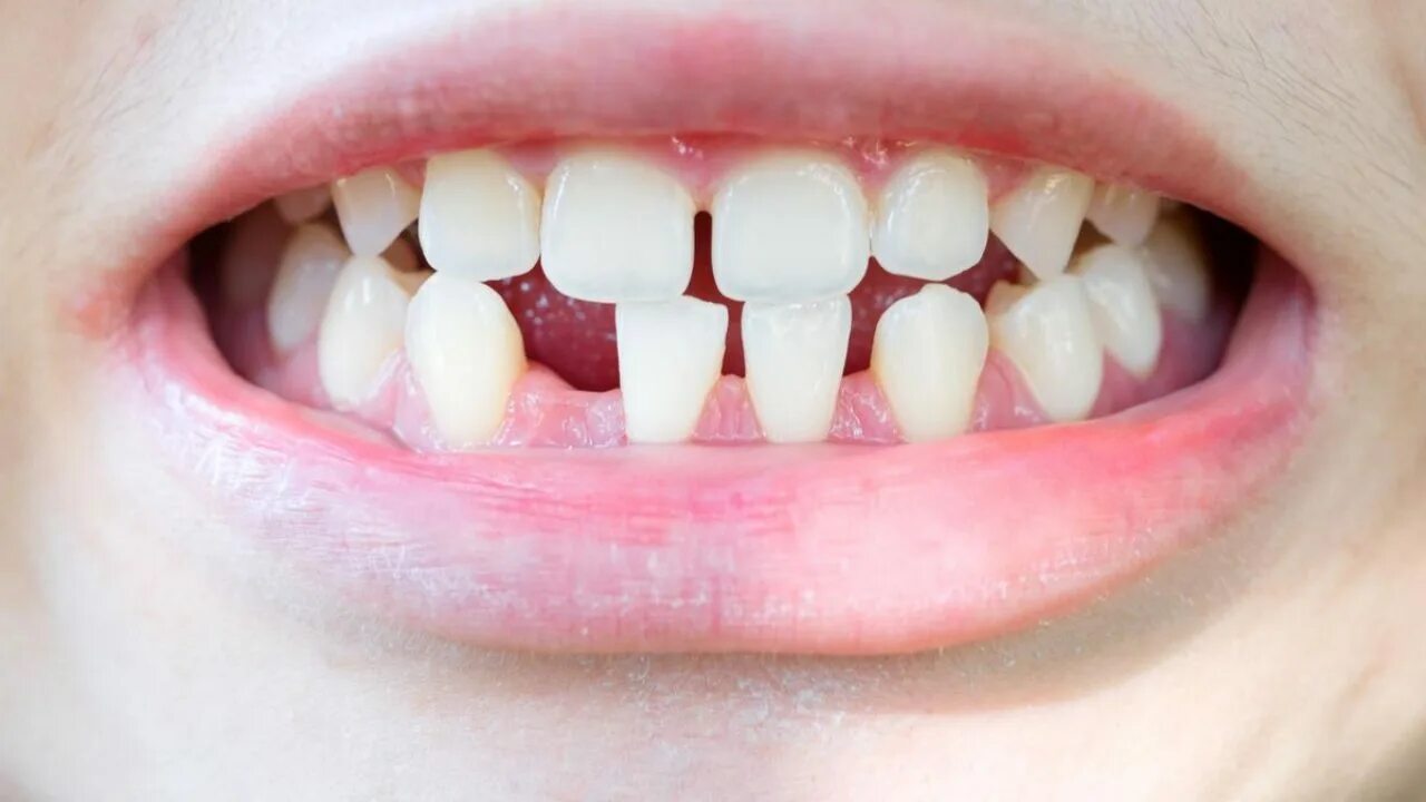 Pointed teeth. Pointed teeth