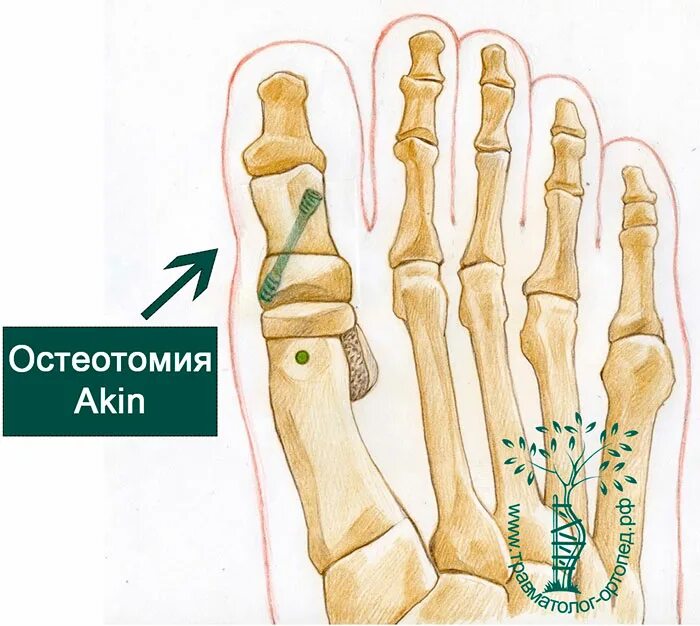 5 фаланга стопы. Акин остеотомия 1 плюсневой. Корригирующая остеотомия 1 плюсневой кости. Операция Scarf Akin остеотомия. Акин остеотомия основной фаланги 1 пальца стопы.