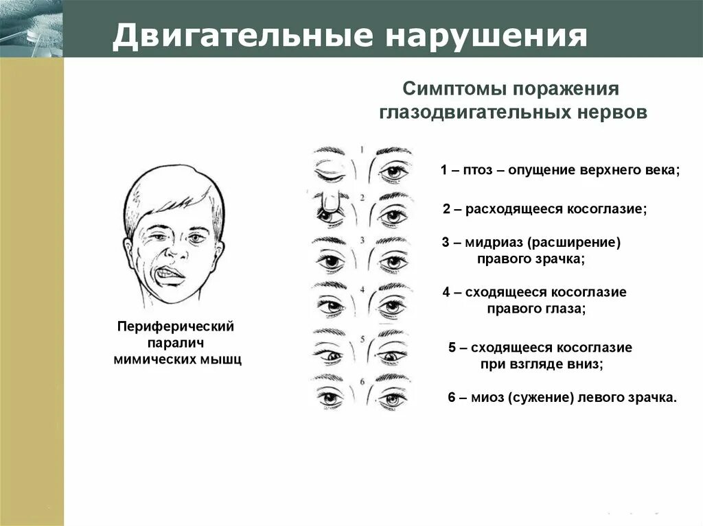 Поражение двигательного нерва. Двигательные нарушения. Двигательные симптомы. «Двигательные нарушени. Поражение глазодвигательного нерва проявление.