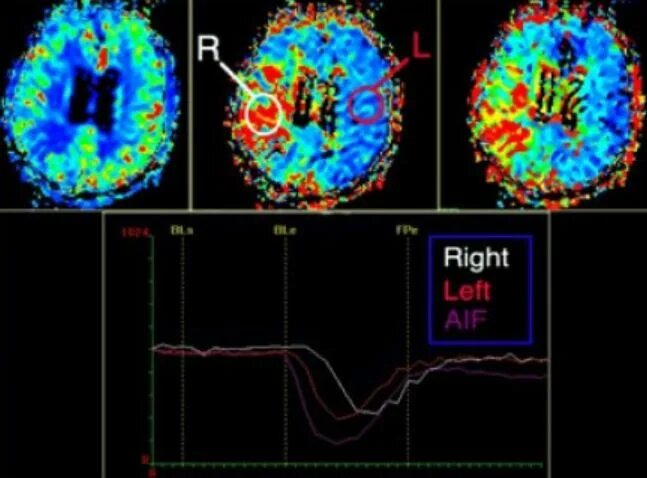 Кт перфузия головного мозга при ишемическом. Перфузия кровотока. Магнитно-резонансная перфузия головного мозга. Кт перфузия головного мозга при ишемическом. Мрт перфузия мозга.