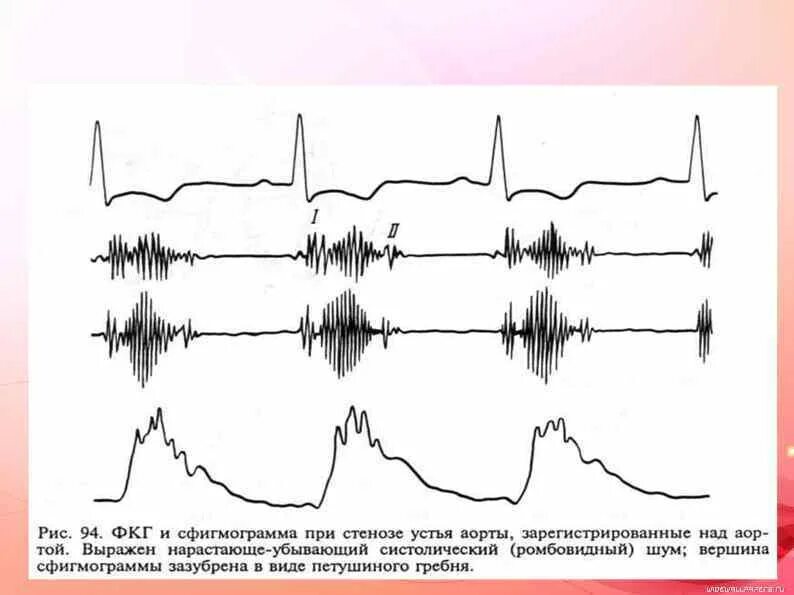 Графическое изображение фкг. Фкг стеноз устья аорты. аортальный стеноз фонокардиография. стеноз клапана легочной артерии фкг. стеноз устья аорты фонокардиограмма.