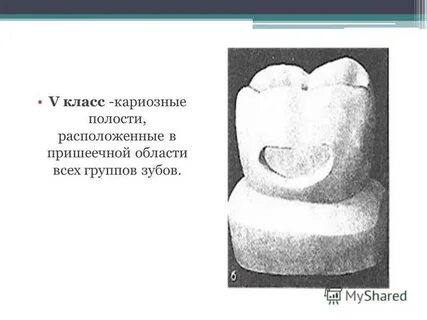 Классы кариозных полостей