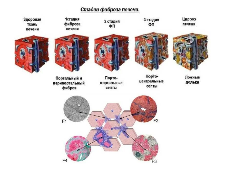 Степени фиброза печени. Портальный фиброз печени. Лечение фиброза печени 3