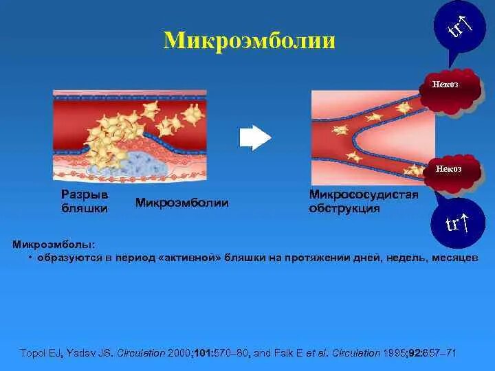 Микрососудистая обструкция. Острый коронарный синдром мкб.