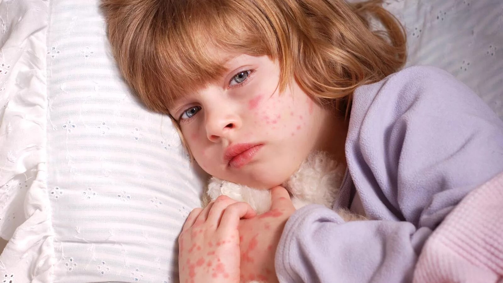 Аллергические заболевания у детей. Краснуха коклюш