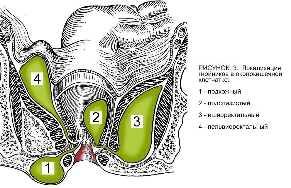 Ректальные железы. Острый подкожно-подслизистый парапроктит. Подкожный ишиоректальный парапроктит. Острый Гнойный пельвиоректальный парапроктит. Параректальные свищи (хронический парапроктит).