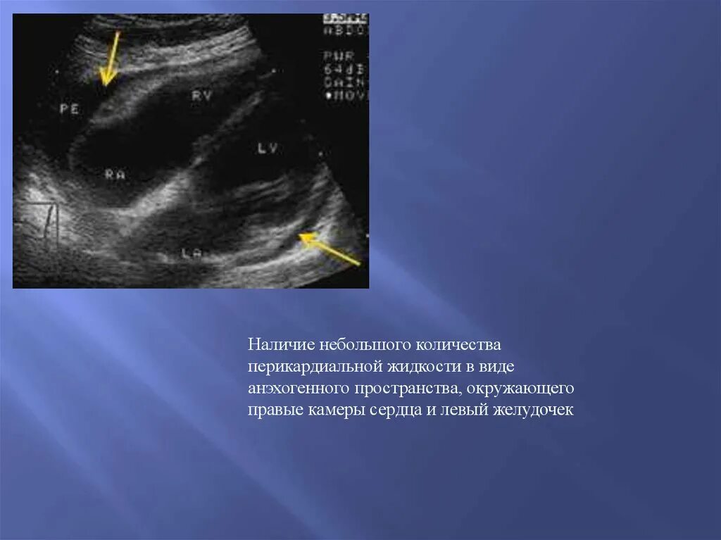 Перикардиальная киста на ЭХОКГ. Анэхогенное скопление жидкости. Анэхогенное образование.