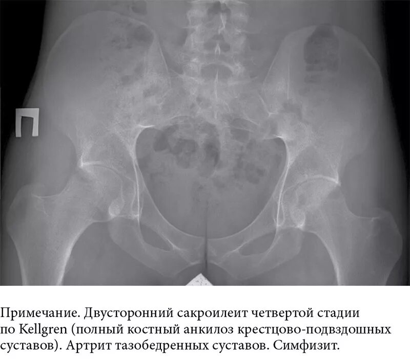 Болезнь Бехтерева рентген сакроилеит. Болезнь Бехтерева рентген крестцово подвздошного. Анкилозирующий сакроилеит. Сакроилеит крестцово-подвздошного сочленения рентген.