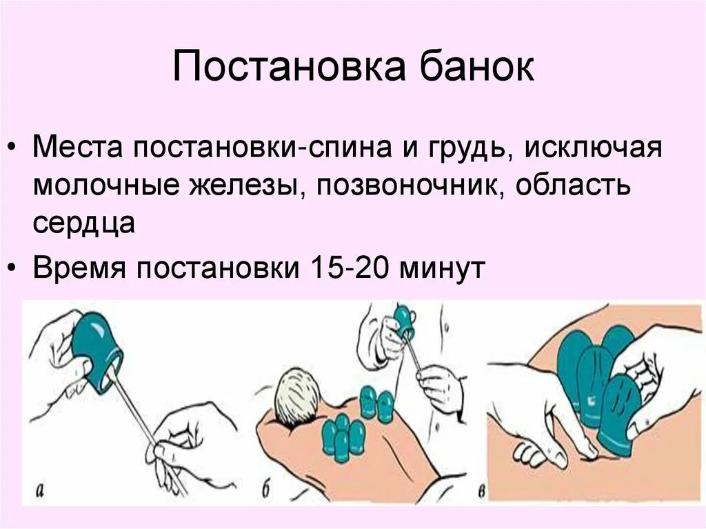 Банки при кашле взрослому как правильно. Постановка мед банок алгоритм. Техника постановки медицинских банок алгоритм. Постановка банок при бронхите алгоритм. Постановка банок и горчичников алгоритм.