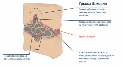 12 грыж