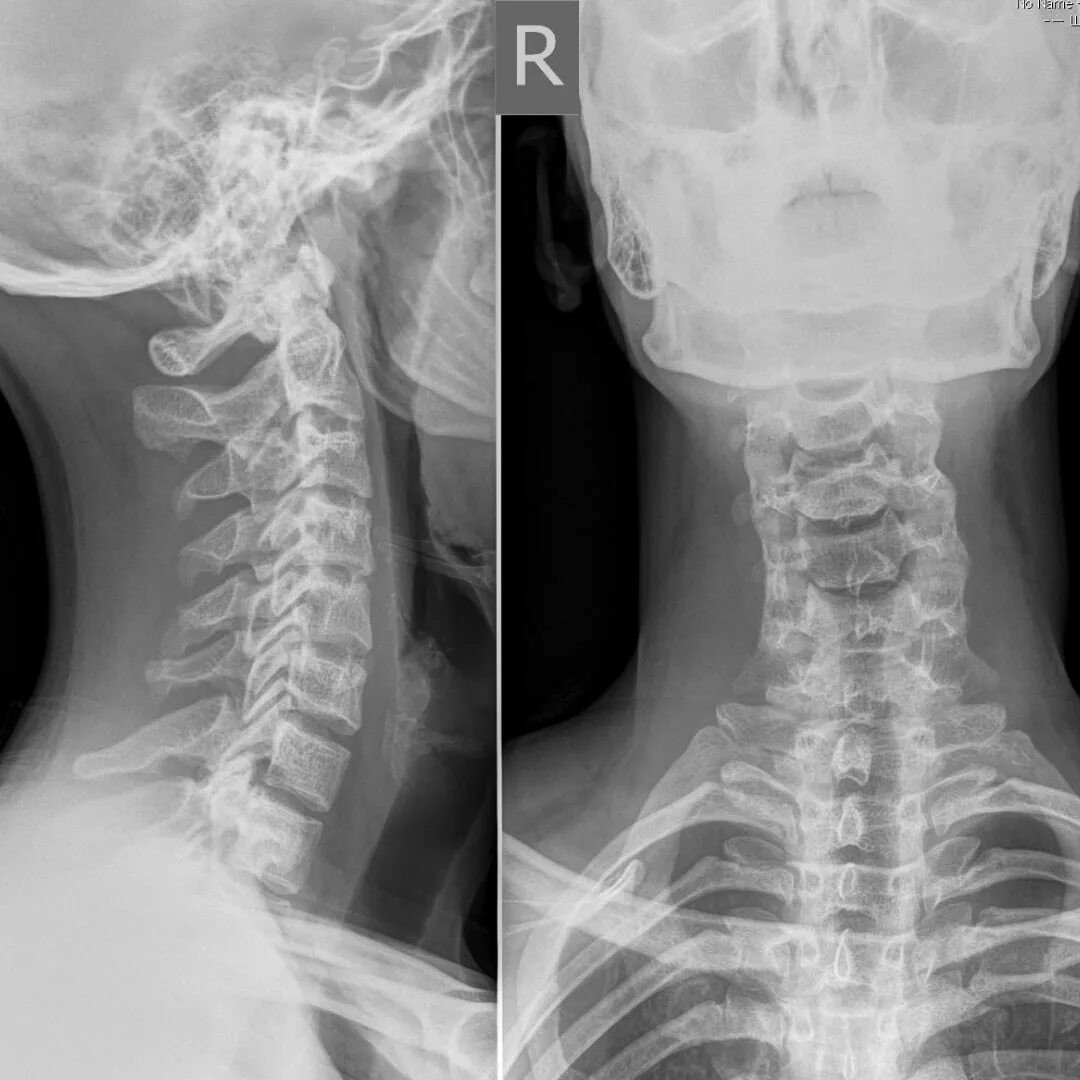 Спинальная нестабильность что это. Сколиоз грудного отдела позвоночника рентген. Шейный отдел позвоночника рентген с1-с2. Лордоз шейного отдела рентген. Левосторонний сколиоз 2 степени шейного отдела.