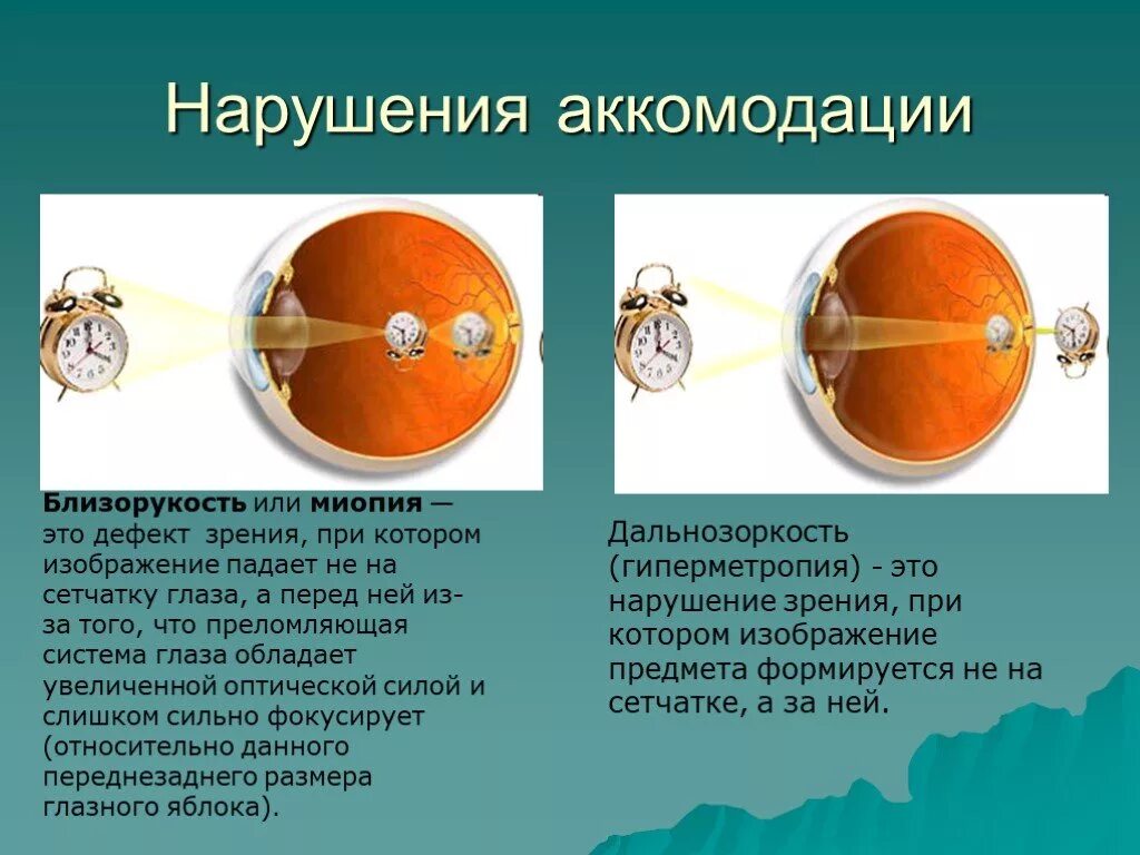 Нарушение аккомодации. Нарушение аккомодации глаза. Нарушение зрения близорукость. Приобретенная близорукость развивается из-за. Причины аккомодации