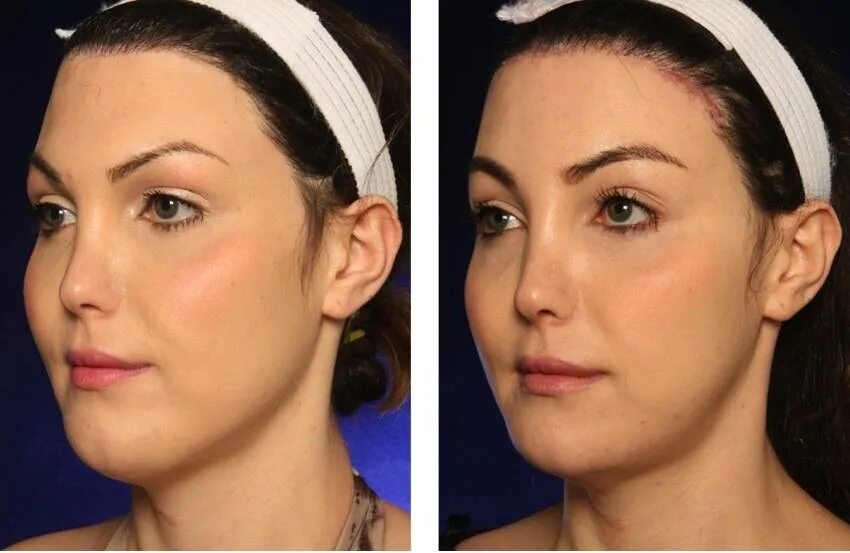 лицо человека и название. операция на овал лица. скошенный подбородок. маленький подбородок. остеотомическая ментопластика.