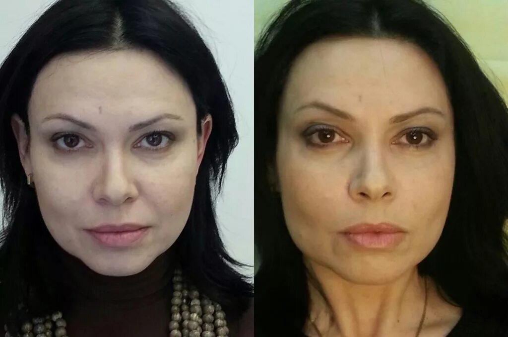 Операция глаз до и после Супер ЛАСИК цены на операцию в Москве Офтальмологическая клиника доктора Кур