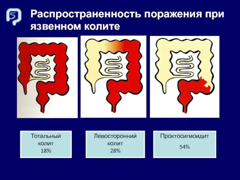 Диарея при язвенном колите