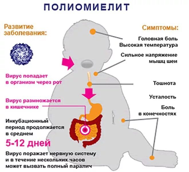 Полиомиелит это простыми словами. Заражение полиомиелитом симптомы. Полиомиелит проявления болезни. Основные клинические симптомы полиомиелита. Клинические проявления полиомиелита у детей.