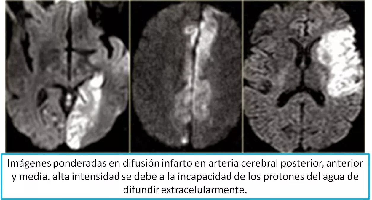 Диффузные нарушения мозга. MRT Dwi головной мозг. Ишемический инсульт мрт. Dwi режим мрт. Ишемический инсульт мрт снимок.