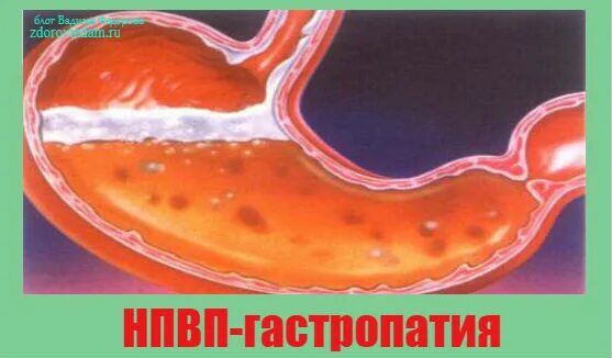 что такое эритематозная гастропатия отдела желудка