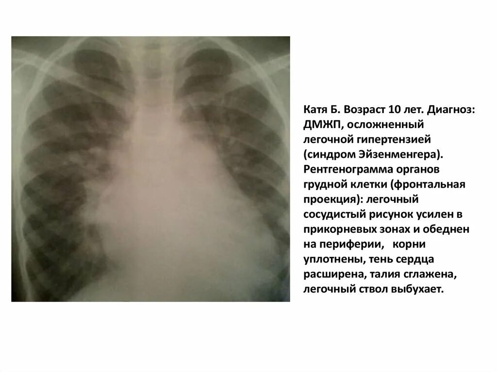 Лёгочная гипетензия ДМЖП. Дефект межжелудочковой перегородки рентген. Дефект межжелудочковой перегородки рентгенограмма. Корни легких уплотнены. Что значит легкие расширены