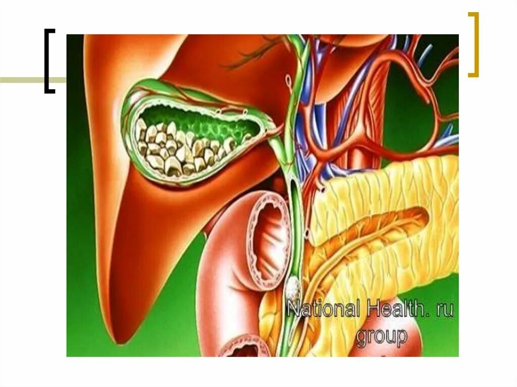 Желчный спазм симптомы. ЖКБ камни желчного пузыря. Желчный пузырь желчнокаменная болезнь. Желчекаменная болезнь холелитиаз. Желчекаменная желтуха.