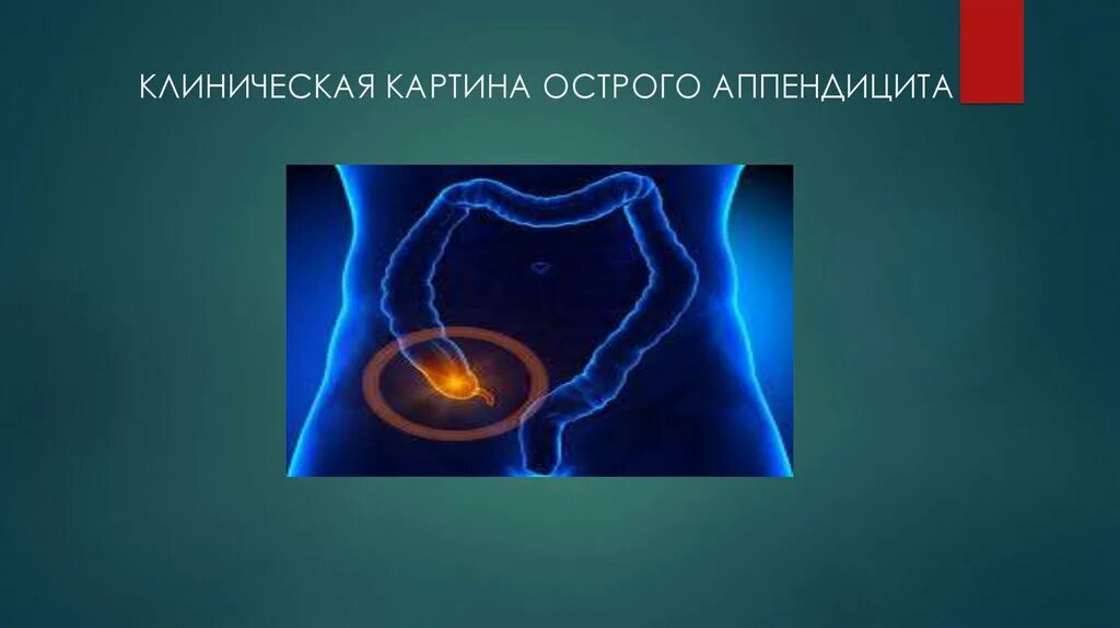 Острый аппендицит первая. Профилактика аппендицита. Клиническая картина острого аппендицита. Буклет на тему острый аппендицит. Профилактика острого аппендицита.