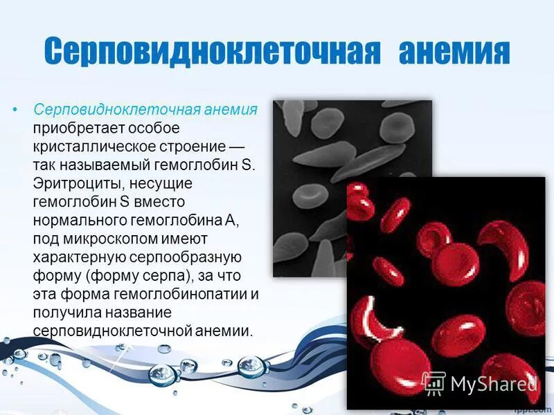 Эритроциты при серповидно клеточной анемии. Гемоглобин серповидноклеточная анемия. Серповидноклеточная анемия строение гемоглобина. Серповидноклеточная анемия эритроциты. Анемия эритроциты и гемоглобин.