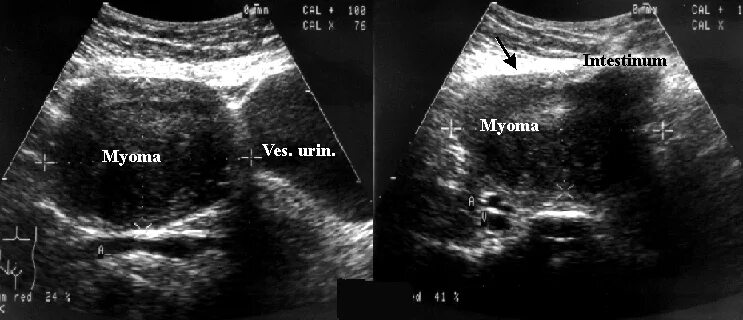 УЗИ множественная миома. Субмукозная миома матки УЗИ. Как на УЗИ выглядит миоматозный узел.