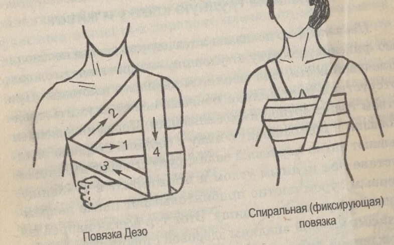 Повязка на грудную клетку алгоритм. Повязка Дезо и Вельпо. Дезо алгоритм наложения. Десмургия повязка Дезо. Порядок наложения повязки Дезо.