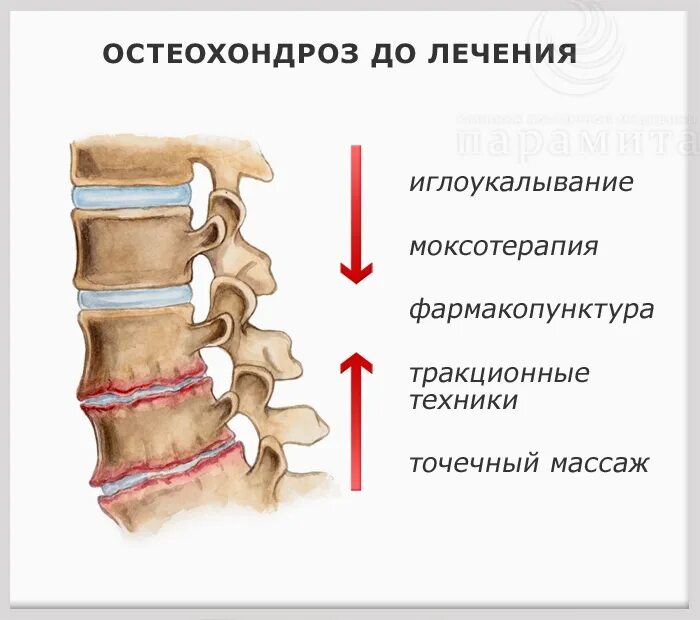 Как лечить поясничного отдела позвоночника