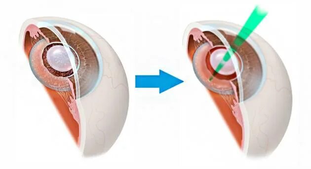 Лазерная дисцизия вторичной катаракты. Дисцизия задней капсулы хрусталика. Вторичная пленчатая катаракта. Фиброзная вторичная катаракта. Вторичная катаракта после операции
