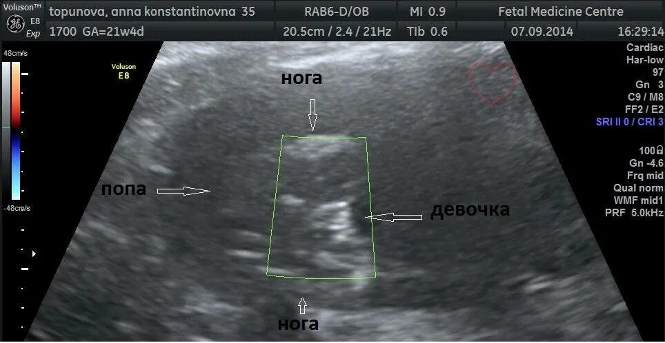 Ошибка узи на неделю. Пол ребенка на УЗИ. УЗИ узнать пол ребенка. Пол на УЗИ. УЗИ определение пола.