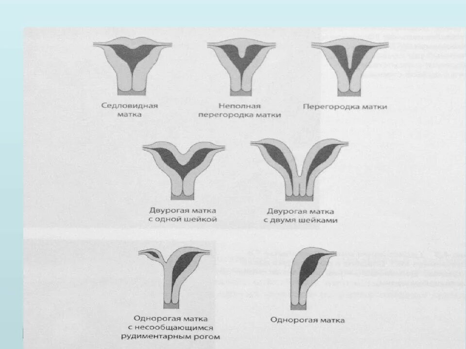 Форма полости матки. Формы матки двурогая матка. Двурогая матка с полной перегородкой. Двурогая седловидная матка. Двурогая матка седловидной формы.