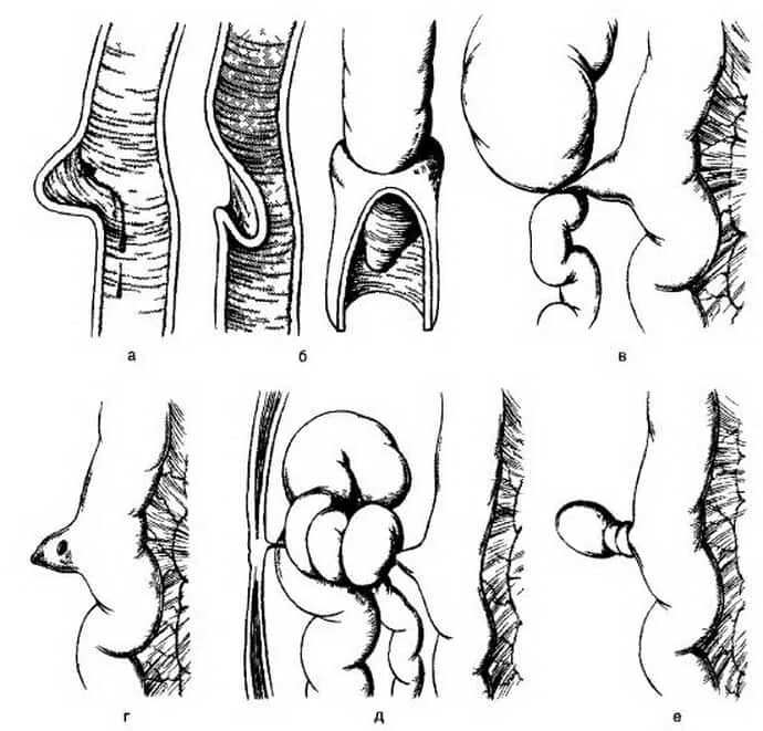 Осложнения дивертикула Меккеля. Дивертикул Меккеля пупок. Дивертикул осложнения