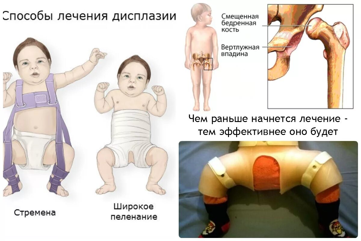 Можно ли вылечить дисплазию