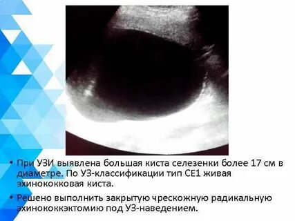 Киста селезенки