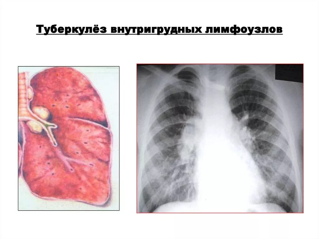 Врожденный туберкулез