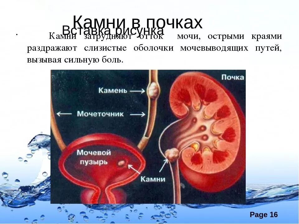 При камнях в почках какую воду пить. Предупреждение заболеваний почек питьевой режим. Предупреждение заболеваний почек питьевой режим 8 класс. Заболевание почек презентация.