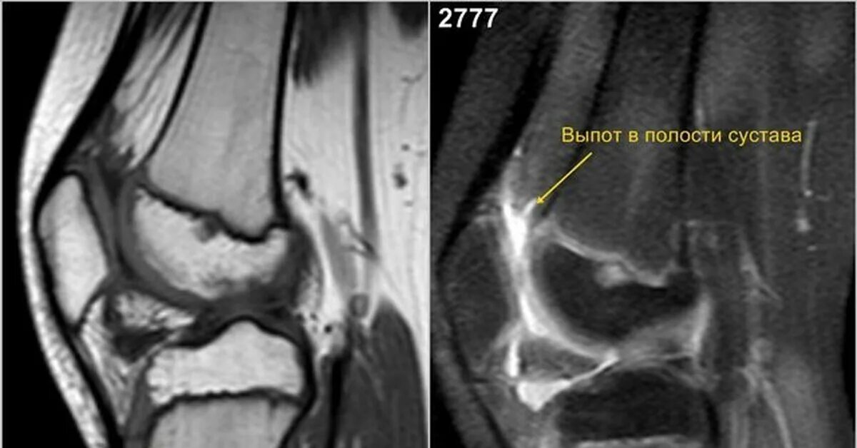 Супрапателлярный синовит. Синовит коленного сустава на мрт что это такое. Болезнь Осгуда Шлаттера мрт.