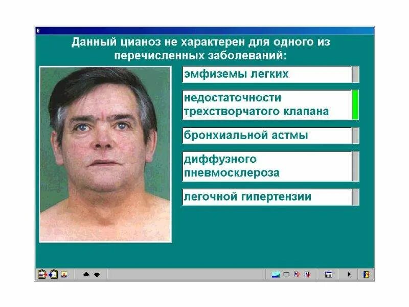 Цианоз при каких заболеваниях. Диффузный центральный цианоз. цианоз при заболеваниях органов дыхания. диффузный цианоз характерен для.