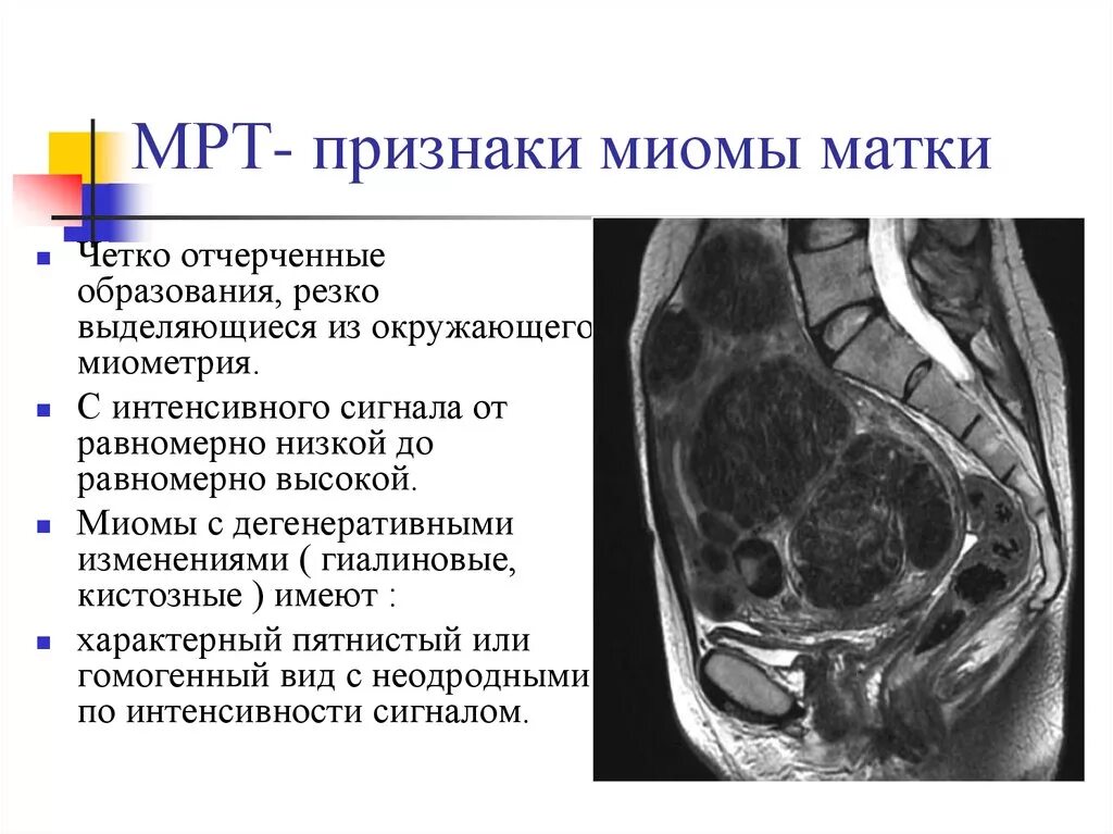 Миома матки симптомы и признаки. Миома матки мрт контрастирование. Миома матки мрт картина. Миома матки забрюшинного пространства.