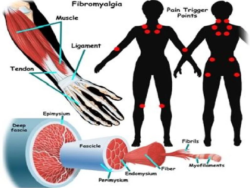 Фибромиалгия триггерные точки. Точки боли при фибромиалгии. Болевые точки при фибромиалгии. Признаки фибромиалгии. Фибромиалгия симптомы причины и лечение