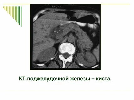 Поджелудочная железа кисты отзывы