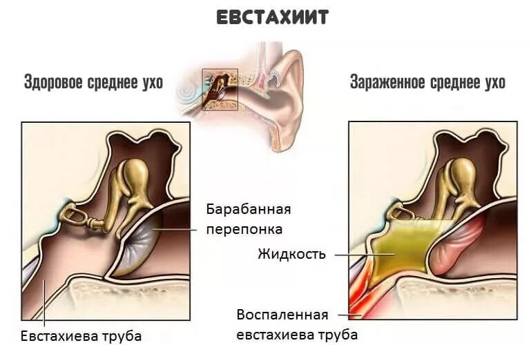 Стучит в левом ухе. Воспаление слуховой евстахиевой трубы. Евстахиит барабанная перепонка. Гной экссудативный отит. Гнойный отит барабанная перепонка.