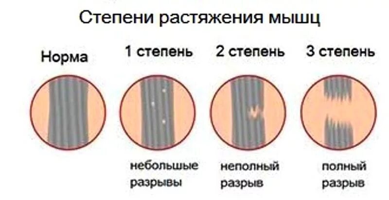 Лечение частичного разрыва мышц. Стадии растяжения мышц. Степени повреждения мышц.