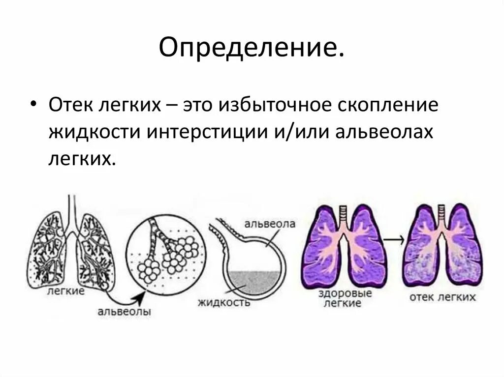 Классификация альвеолярного отека легких. Отек легких сопровождается